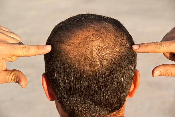 scalp hair loss