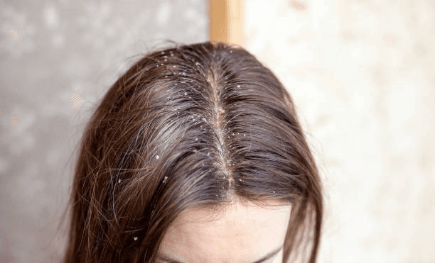 dandruff